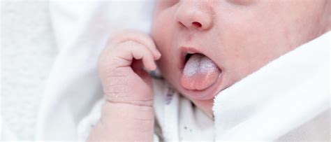 Spruw in de mond en luiergebied baby