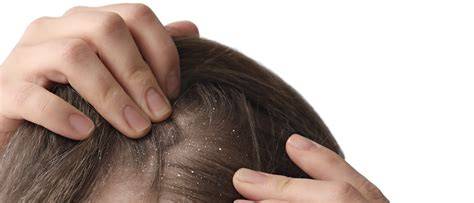 Trichoscopie van hoofdhuid en haarzakjes