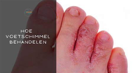 Voetschimmel tussen tenen herkennen