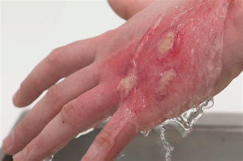 Hand onder stromend water bij chemische brandwond