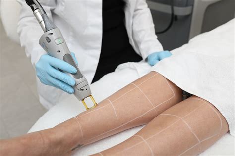 werking van laserontharing haarzakje