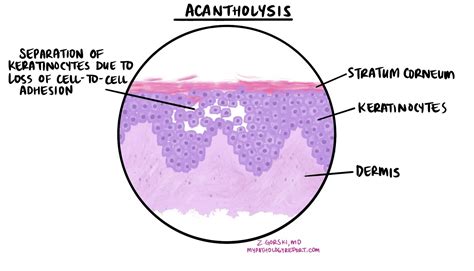 Doorsnede epidermis met acantholyse