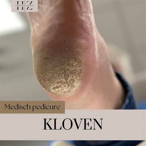 Oorzaken van kloven aan handen en hielen