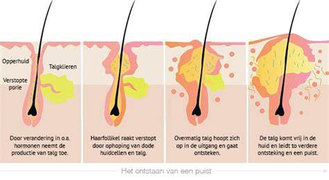 Verstopte porie en ontstaan puistje
