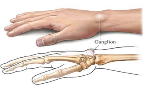 ganglion als bultje op hand en pols
