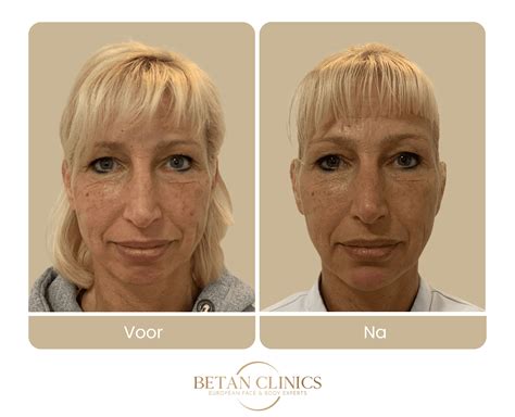 Mesotherapie gezicht voor en na resultaat