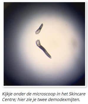 Huidmonster op objectglaasje onder microscoop